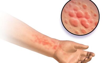 Manifestaciones de la esquistosomosis en humanos